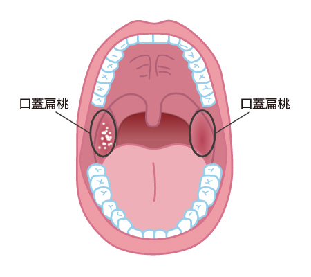 扁桃炎