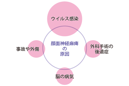 顔面麻痺の原因