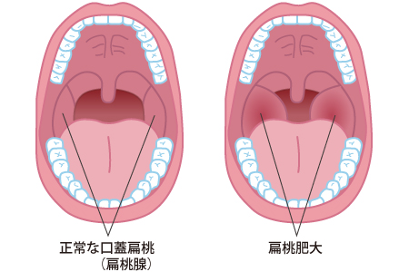 扁桃肥大