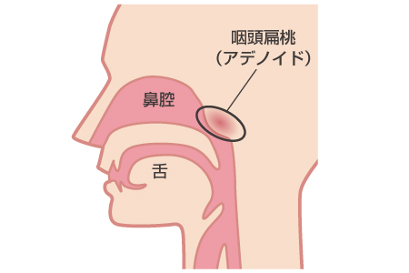 アデノイド肥大